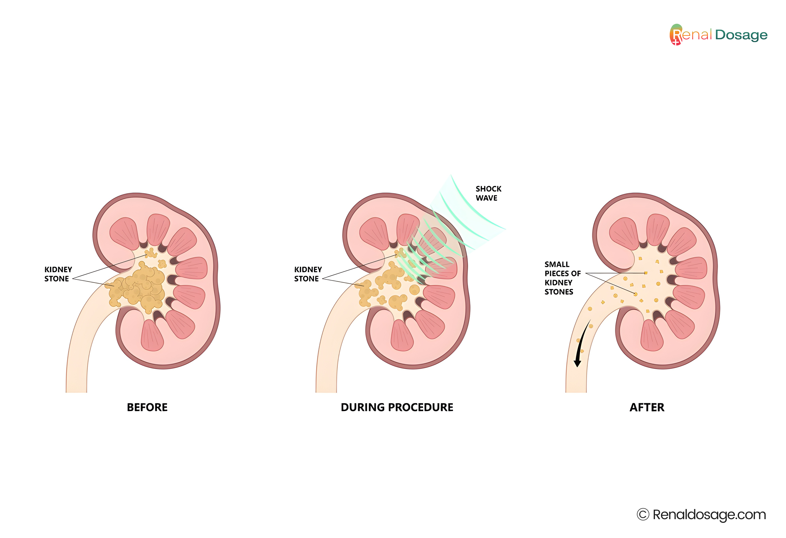 RenalDosage - What is a Kidney Stone? types, causes & Treatments